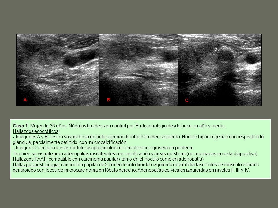 Imagenes ecograficas de tiroides